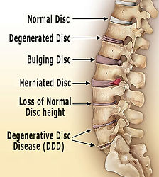 Degenerative Disc Disease Treatment Cary NC | Triangle Spinal